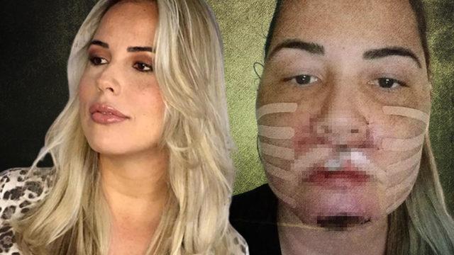 Estetik operasyonlar kabusu oldu! Yüzünün şekli tamamen bozuldu... “Yüzümü geri istiyorum”