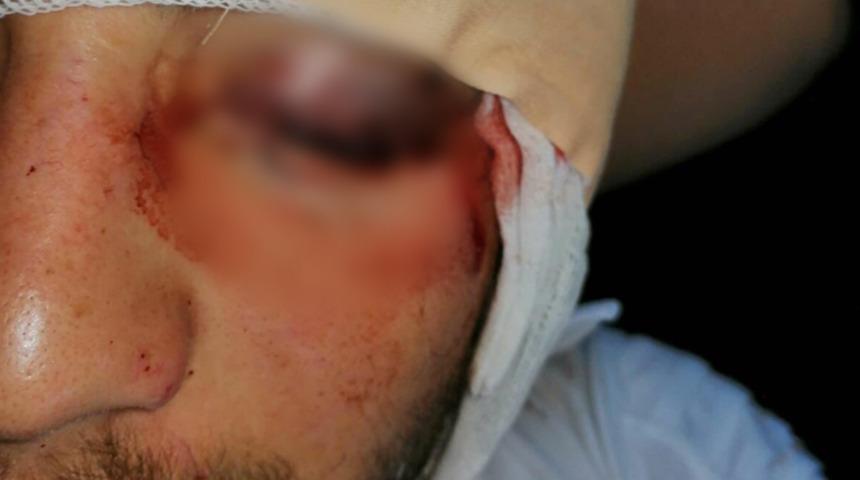 Kavgayı ayırmaya çalıştı, gözünden oldu! İddianame, 3 yıl sonra hazırlandı... 10,5 yıl hapis istemi