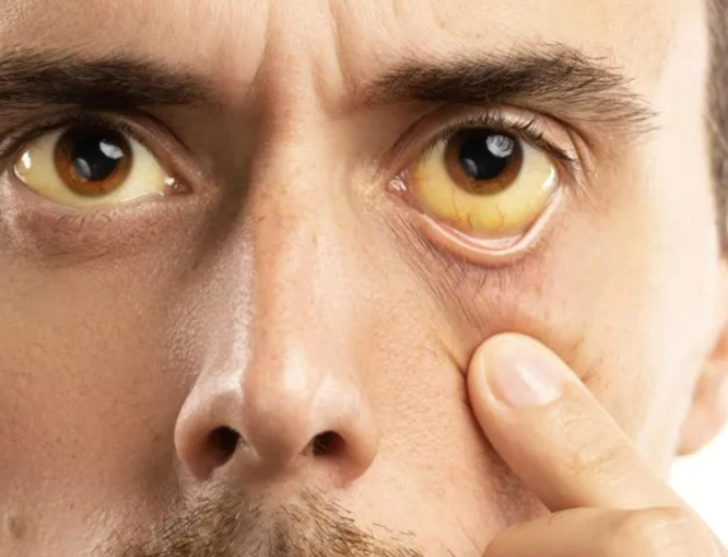 En ölümcül kanser türü olarak biliniyor! Hayatınızı kurtarmak için belirtilere dikkat edin G5