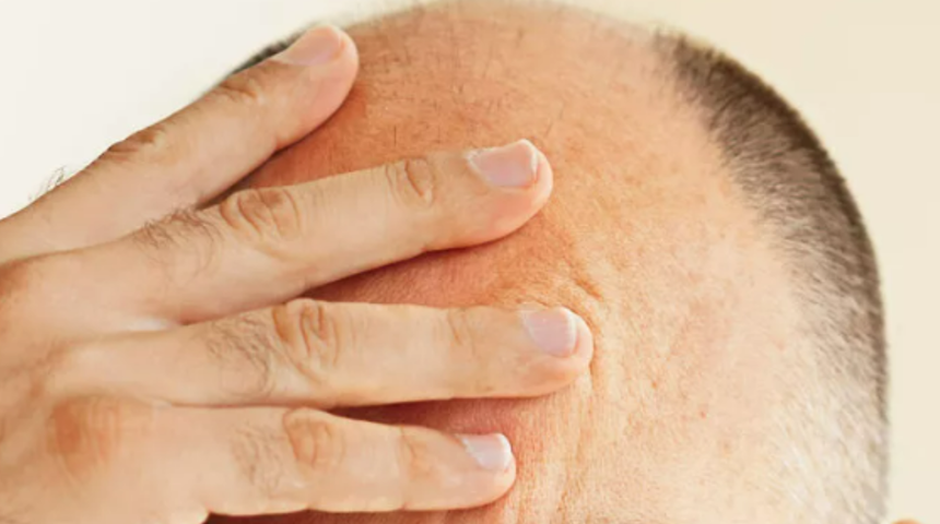 Evinize bile sokmayın! Sadece ufacık bir teması kelliğe yol açabilir: Tehlikeleri hiç bilinmiyor