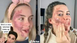 TikTok'ta hastalığını paylaştı! Dermatolog tarafından sahtekarlıkla suçlandı