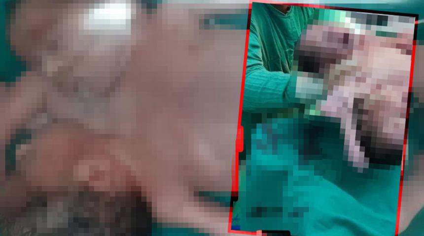 İki başlı, dört kollu ve iki bacaklı olarak dünyaya gelen yapışık ikiz kardeşler doktorları bile şaşkına çevirdi