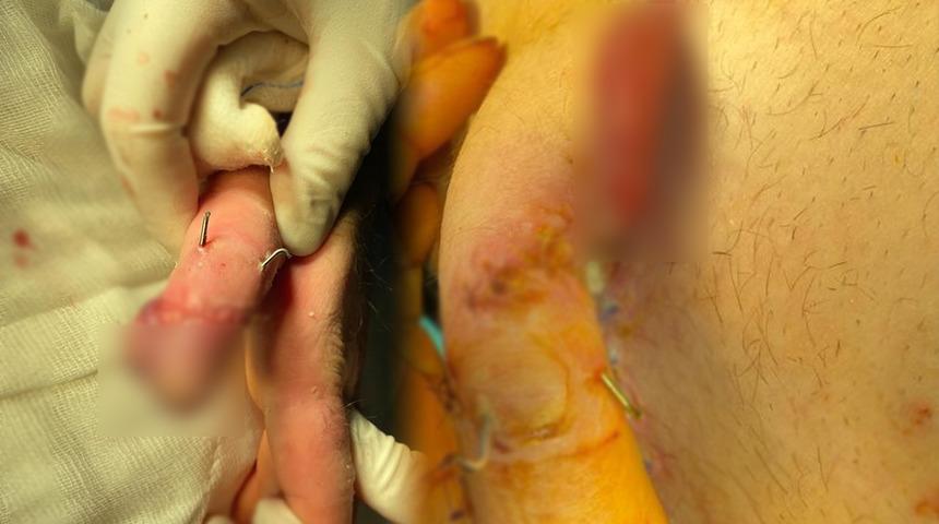 Göbeğinde yeniden büyütüldü! 3 haftada yeniden oluştu: Karnıma gömdüler