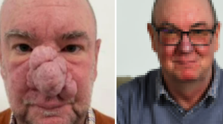 Her şey ufak kırışıklıkla başlamıştı! 'Fil adam' gibi hisseden adam ameliyattan sonraki g&ouml;r&uuml;nt&uuml;s&uuml;n&uuml; paylaştı