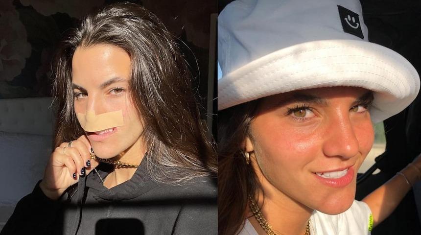 Korkunç saldırıdan sonra hayatı tamamen değişti! Suratına saldırıp asılan köpek onu üst dudaksız bıraktı