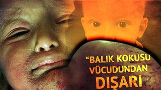 Ne güneşe çıkabiliyor ne sıcağa! 'Balık pulu' hayatını kâbusa çevirdi... Nadir hastalığa sahip Muhammet Taha'nın babası: Doktorlara göre tedavisi yok