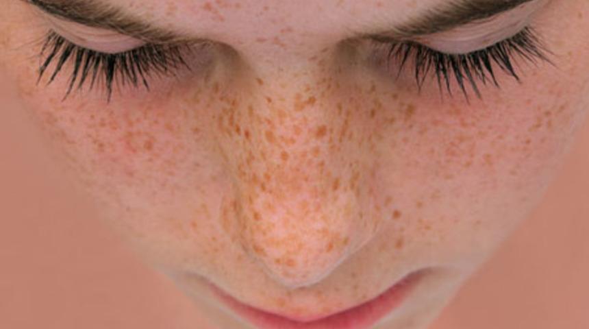 G&uuml;neş İz Bırakmasın!