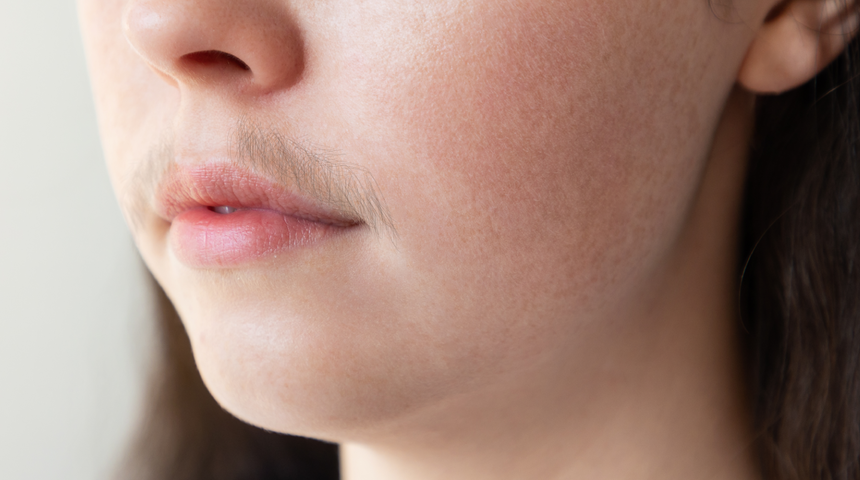 Her şey vücudunda çıkan tüylerle başladı! Önemsiz görülüyor ama kanserin belirtisi olabilir