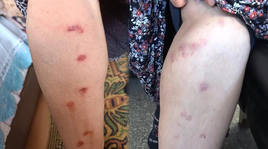 Bir güzellik merkezi skandalı daha! Kabusu yaşadı, belinden aşağı her yer yandı