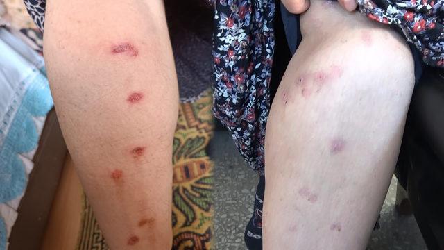 Bir güzellik merkezi skandalı daha! Kabusu yaşadı, belinden aşağı her yer yandı