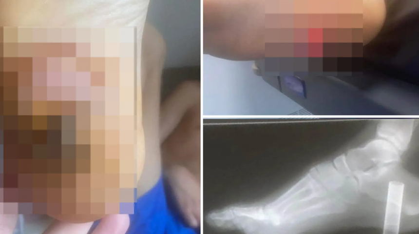 Eğlencenin sonu kötü bitti: Ayağına saplanan elektronik sigara yüzünden ayağını kaybedebilir