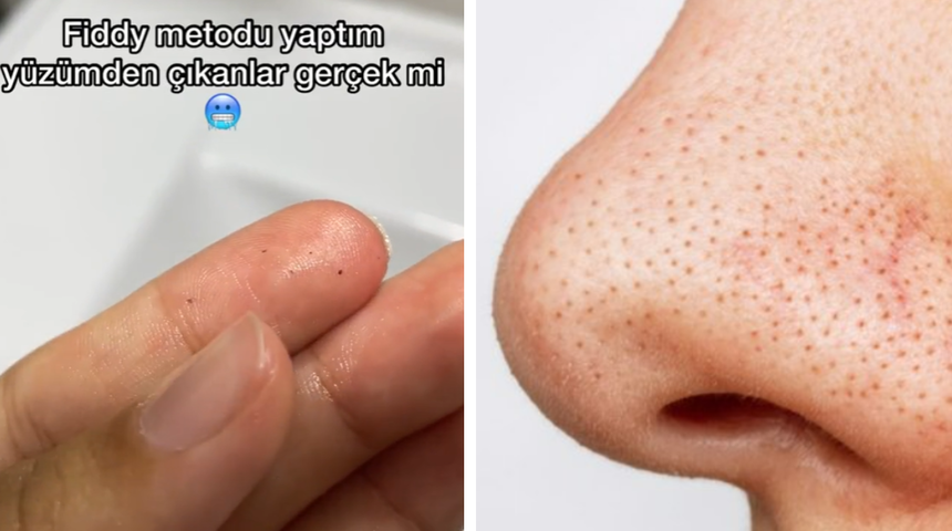 TikTok'ta viral oldu: Siyah noktaları teker teker döküyor! Fiddy metoduyla siyah noktalardan kurtulun