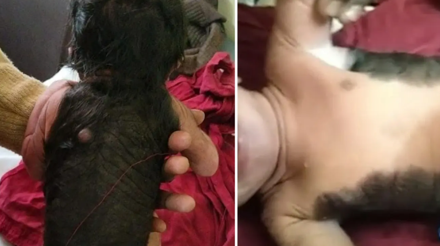 Hindistan'da dünyaya gelen bebek doktorları hayrete düşürdü! Vücudunun yarısı kılla kaplı