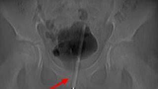 Cinsel zevk için canından oluyordu! Mesanesinden çıkanı görenler gözlerine inanamadı