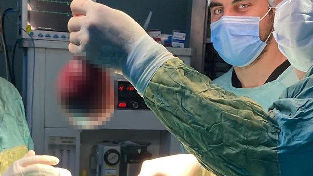 Ameliyat korkusundan yıllarca doktora gitmedi! İkna edilince boynundan çıkartıldı: Tam 800 gram ağırlığında