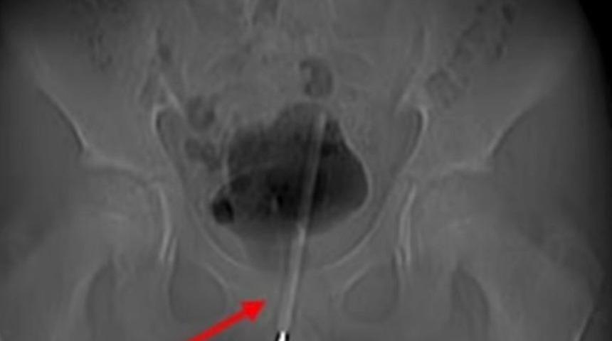 12 yaşındaki çocuğun penisinden termometre çıkması herkesi şaşkına çevirdi! Anne korkuyla hastaneye koştu