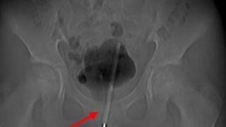 12 yaşındaki çocuğun penisinden termometre çıkması herkesi şaşkına çevirdi! Anne korkuyla hastaneye koştu