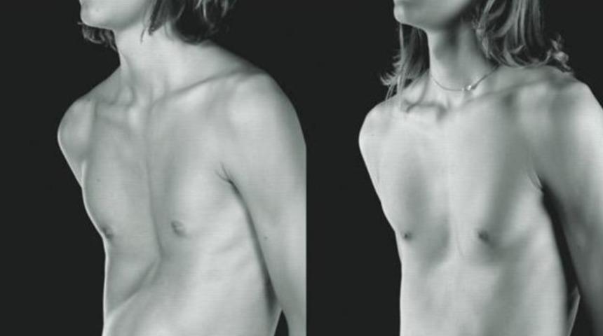 Metal barsız kunduracı ve güvercin göğsü ameliyatları