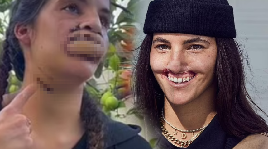 Pitbull saldırısı nedeniyle gülüşünü kaybetti! Dehşet anlarını teker teker anlattı