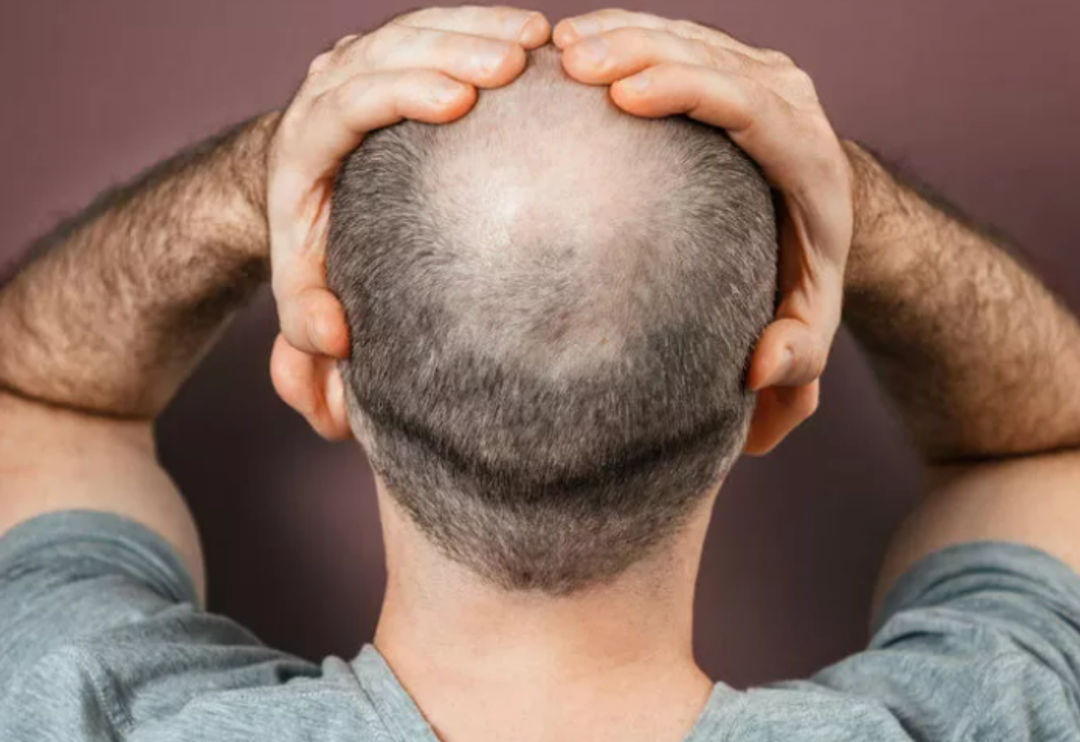 Direkt lavaboya d&ouml;k&uuml;n! Sadece bir bardağı bile kel kalmanıza neden olabilir