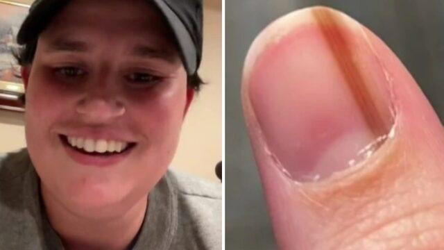 Tırnak çizgisinin havalı olduğunu düşündü! Gerçekleri öğrenince hayatının şokunu yaşadı: Ölümcül hastalığın belirtisi