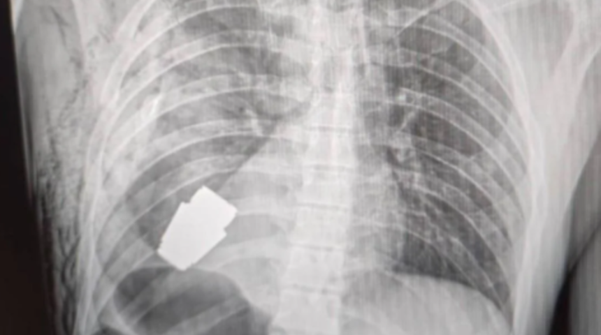 Dünyanın en tehlikeli ameliyatında ölüme meydan okudu! Ukraynalı askerin vücudunda sıkışan patlamamış el bombası çıkartıldı