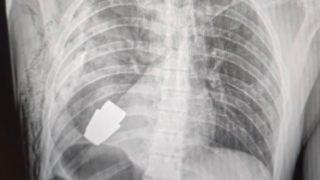 Dünyanın en tehlikeli ameliyatında ölüme meydan okudu! Ukraynalı askerin vücudunda sıkışan patlamamış el bombası çıkartıldı