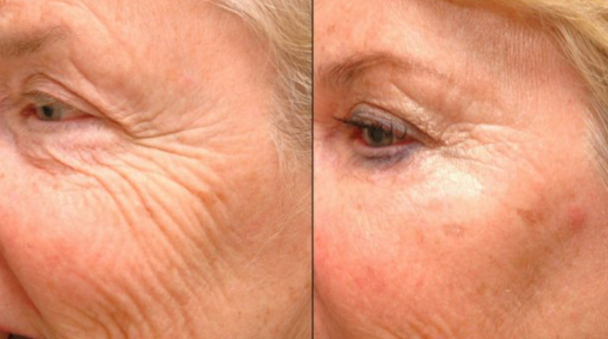Boşuna para vermeyin: Doğal botoks etkisi yaratıyor! Yaşlılık izlerini silip süpürüyor
