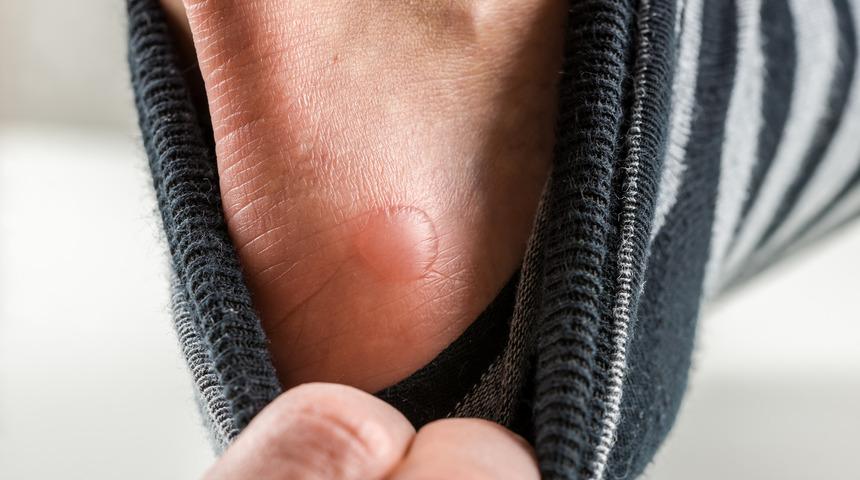 Bu bitkisel &ccedil;&ouml;z&uuml;mle su toplayan ayaklarınıza derman olabilirsiniz 