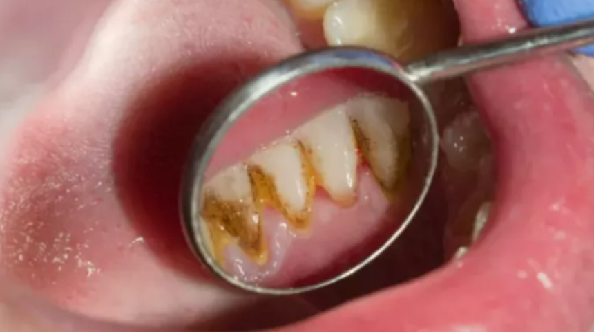 Çözümü kolay! Diş tartarını ve taşlarını temizlemenin en etkili yolu