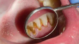 Çözümü kolay! Diş tartarını ve taşlarını temizlemenin en etkili yolu