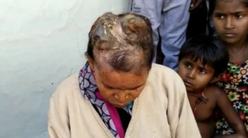 Kimse inanmamıştı! Kafasında boynuzlar çıkan kadının çektiği acının tarifi yok