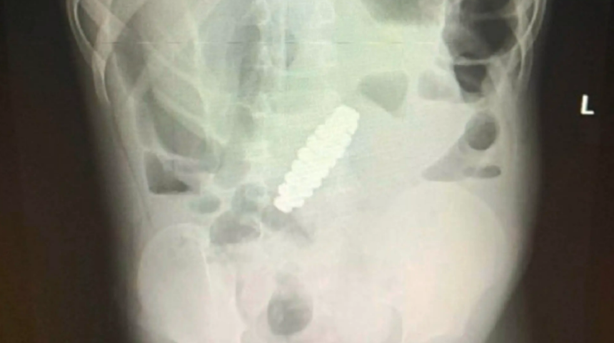 Şiddetli karın ağrısının nedeni herkesi şok etti! Yanlış teşhis nedeniyle apandisti alındı ama gerçekler bambaşkaydı...