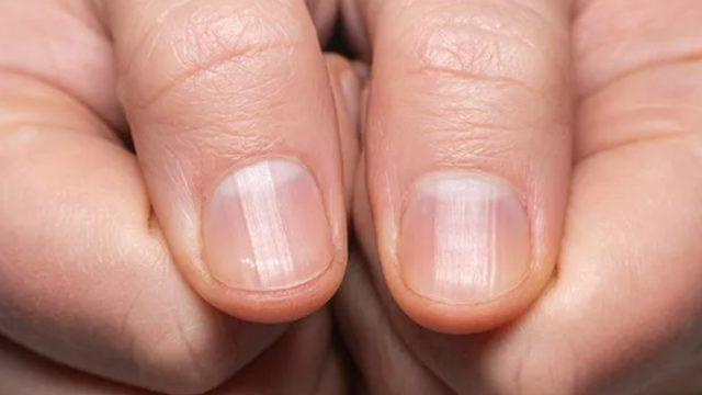 Sakın önemsiz görmeyin: Tırnağınızda görülen ufak değişikliklere dikkat! Tümör habercisi olabilir