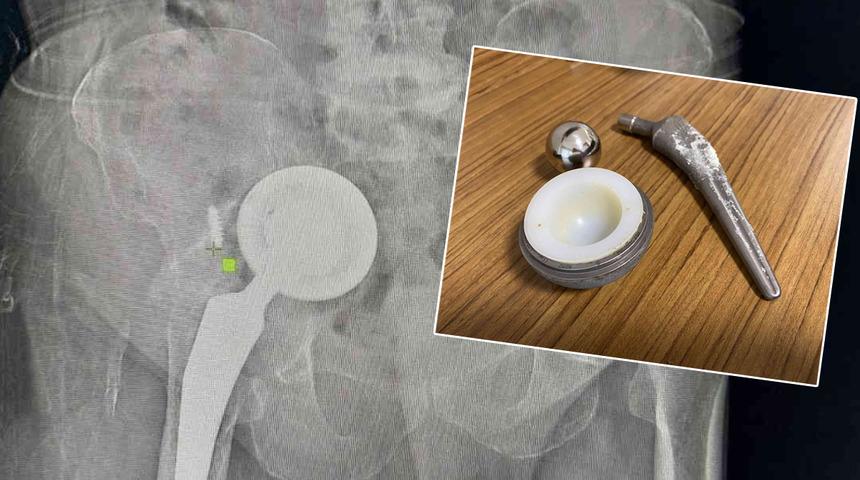 Kalça protezi karnından çıktı! Doktorları bile gözlerine inanamadı 'Karnıma girse fark ederim diye düşündüm ama...'