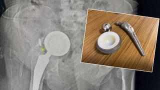 Kalça protezi karnından çıktı! Doktorları bile gözlerine inanamadı 'Karnıma girse fark ederim diye düşündüm ama...'