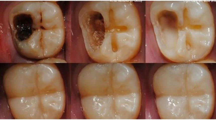 Diş &ccedil;&uuml;r&uuml;mesinin &ouml;n&uuml;ne ge&ccedil;ecek doğal y&ouml;ntemler