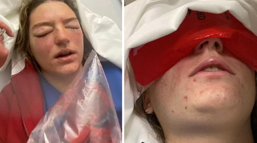 Sadece kurabiye yapmak istemişti! Bir anda yüzünde patladı... Neredeyse kör kalıyordu!