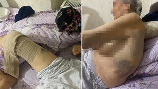 Bakıcı dehşeti: Başından aşağı sıcak yemek döktüler! Hastanede ölüm kalım savaşı veriyor