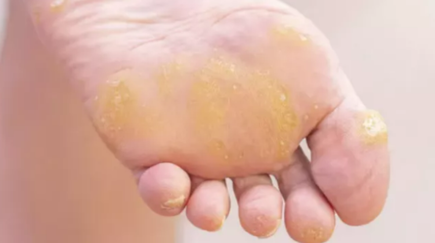 Ayak nasırının kökünü kurutuyor! Her evde bulunuyor