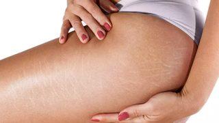 Sadece iki malzeme ile vücut çatlaklarını siler süpürür! Çatlak görünümünü en aza indirmek için...