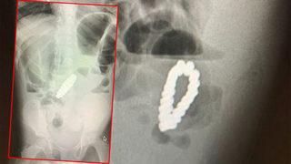 Karın ağrısı şikayetiyle hastaneye götürülen 4 yaşındaki çocuğun midesinden bilezik çıktı! Doktorlar bile ne olduğunu anlayamadı