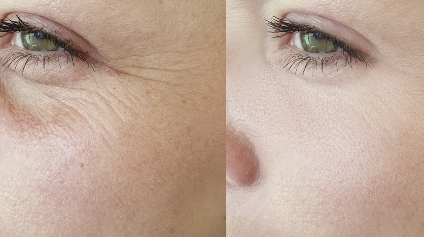 Yüzdeki kırışıklıkları tamamen geçiren doğal botoks yöntemini açıkladı! "İğrenç ama işe yarıyor"