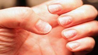 Demir eksikliğiniz olabilir mi?