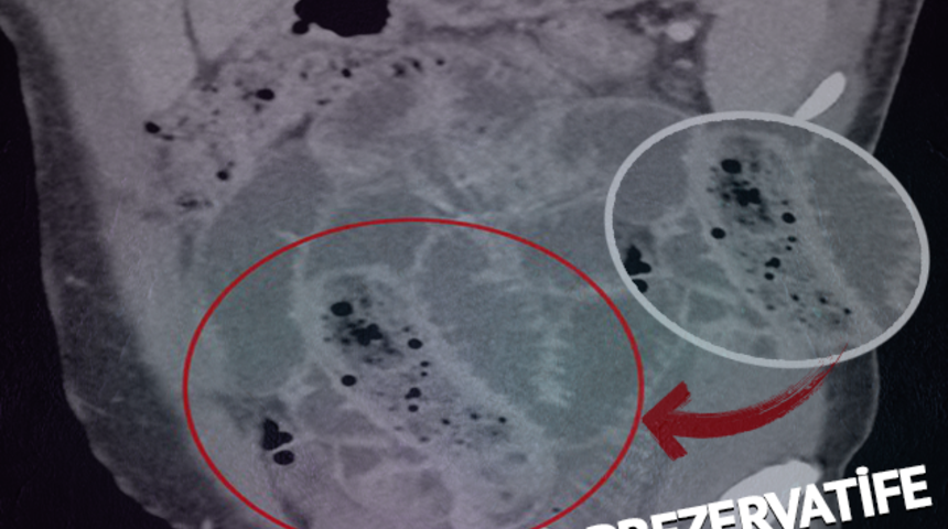 Cinsel organından prezervatife sarılı muz çıktı! Doktorları bile şaşkına çeviren adam kendisini “Öfke nöbeti” diyerek savundu