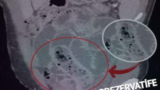 Cinsel organından prezervatife sarılı muz çıktı! Doktorları bile şaşkına çeviren adam kendisini “Öfke nöbeti” diyerek savundu