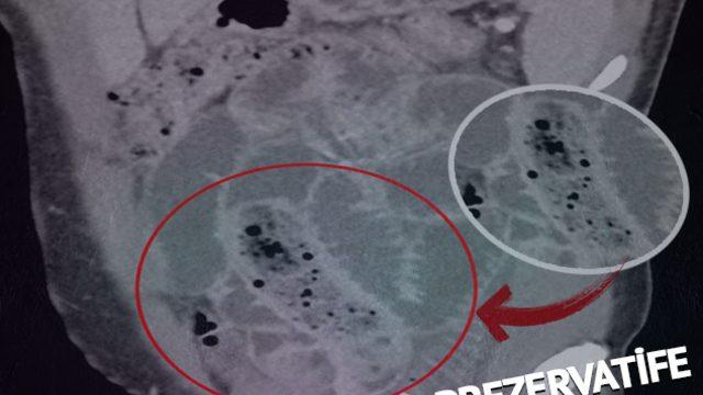 Cinsel organından prezervatife sarılı muz çıktı! Doktorları bile şaşkına çeviren adam kendisini “Öfke nöbeti” diyerek savundu