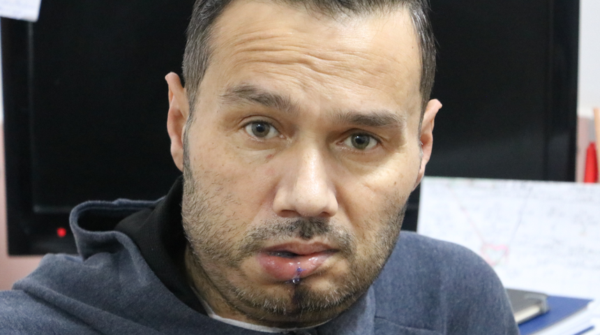 Her şey ağzında geçmeyen ufak bir yarayla başladı! Çenesi kesilerek kaval kemiğinden parça takıldı