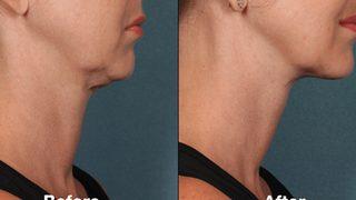 Gıdınızdan kurtulmanızı sağlayacak en etkili egzersiz! Evde gıdınızı yok edebilirsiniz