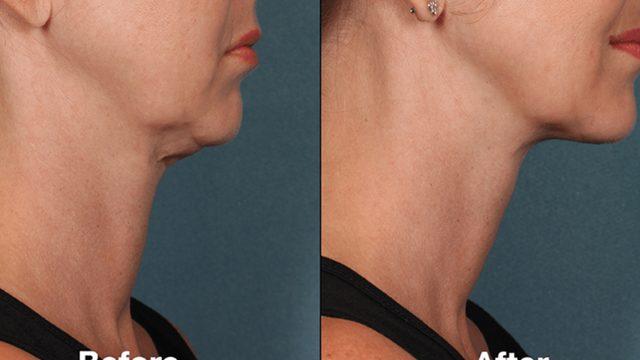 Gıdınızdan kurtulmanızı sağlayacak en etkili egzersiz! Evde gıdınızı yok edebilirsiniz